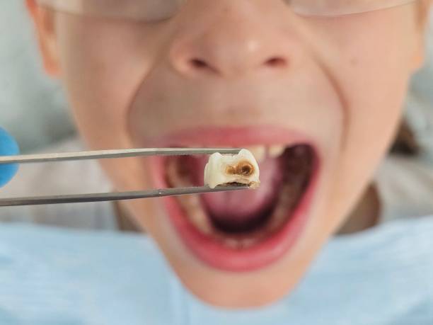 Best Emergency Root Canal Treatment in Alderson, WV