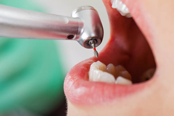 Best Emergency Treatment for Dental Infections or Abscesses in Alderson, WV